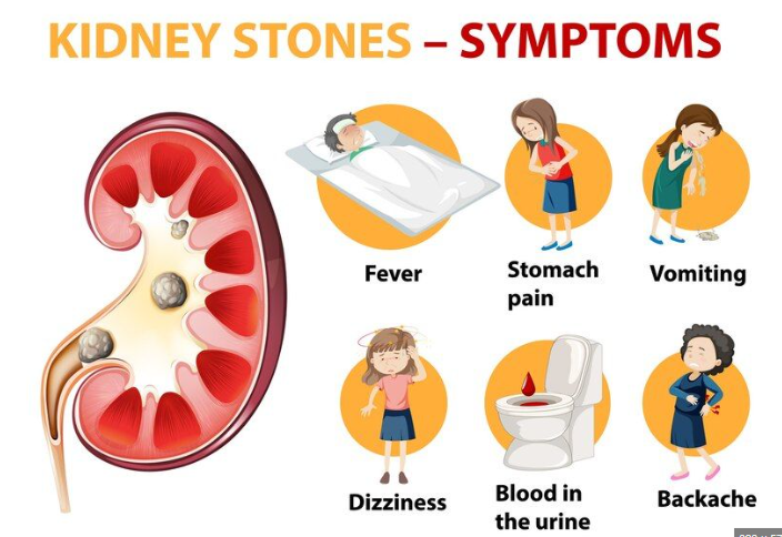 What are the first signs of kidney stones